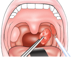 علاج اللوز بطرق بسيطة ووصفات طبيعية ويب طب