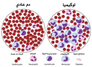 blood-cancer