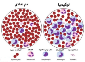 هائله مرض تنتج باعداد اللوكيميا سرطان في الدم تنتج في