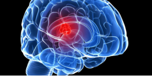 brain-tumors