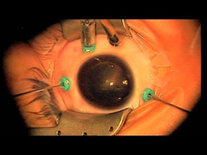 eye-operation