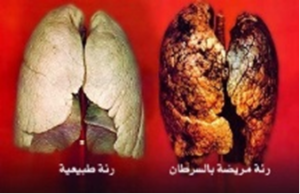 lung-cancer