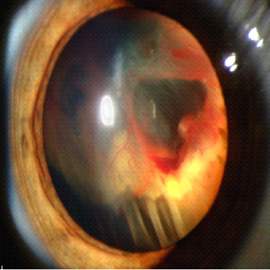 عملية تمزق شبكية العين وعلاج سرطان الشبكية - ترابجو، دليل العلاج بالخارج