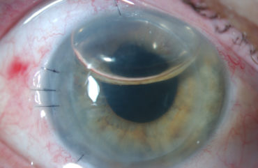 عملية زراعة العين وتركيب العدسات الصلبة - ترابجو، دليل العلاج بالخارج